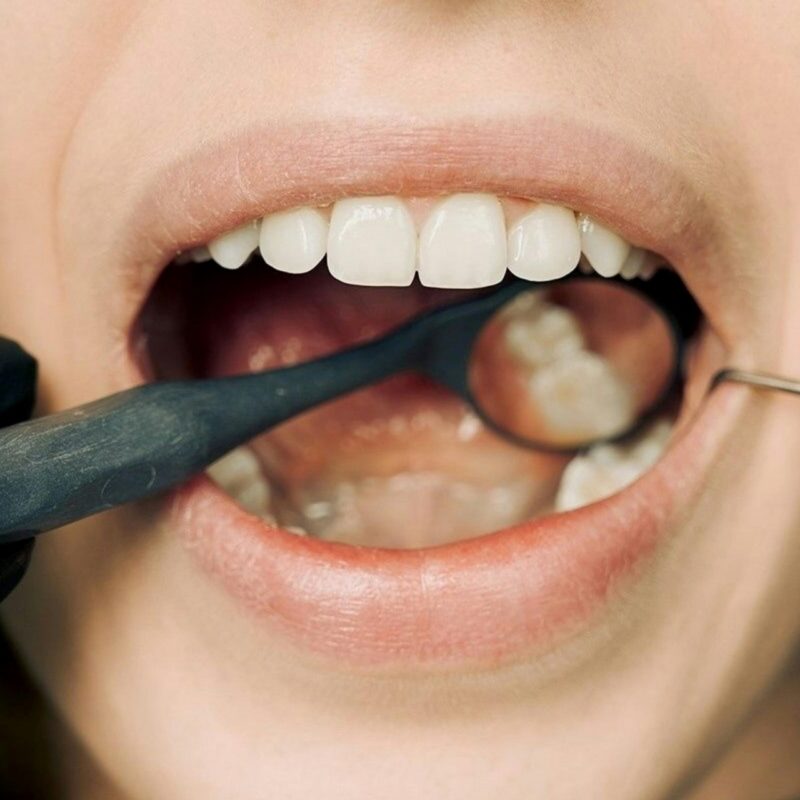 You might need a filling replacement if you feel sensitivity, pain, or cracks on your filling.