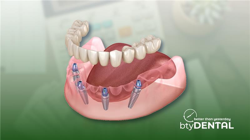A complete guide to understanding the All On 4 dental implant cost in Washington, including what’s included and how to budget.
