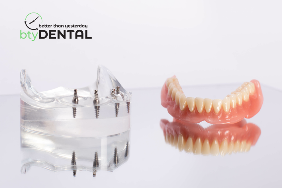 Here's all you need to know about all-on-4 dental implants in Washington