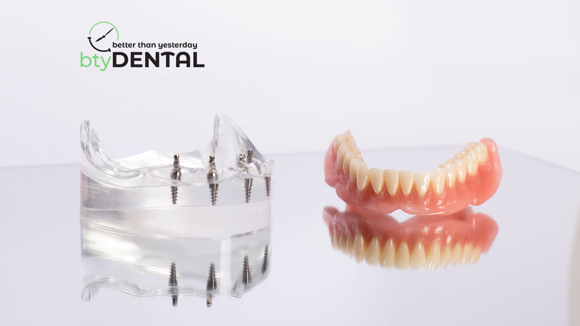 Here's all you need to know about all-on-4 dental implants in Washington