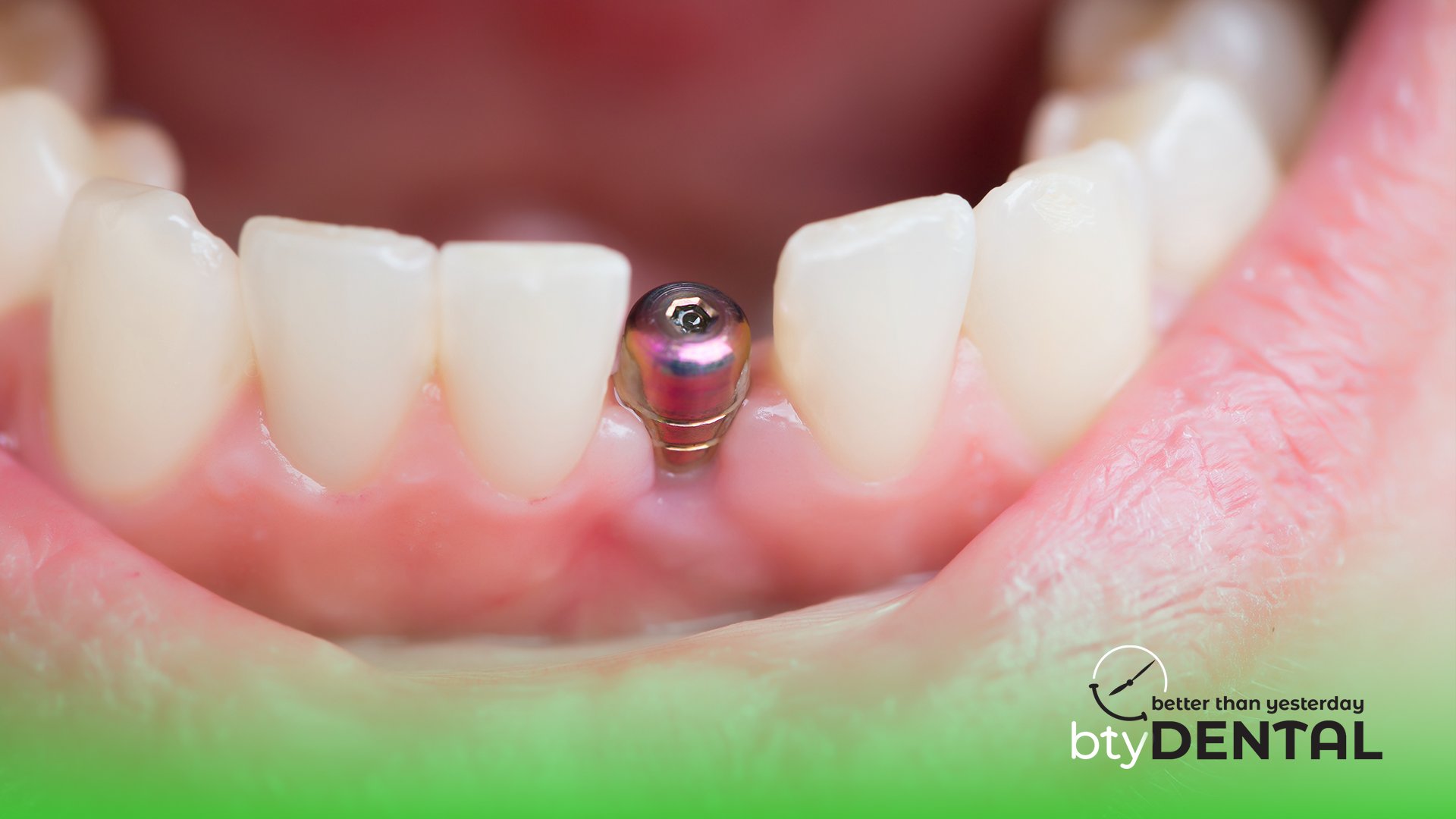 Here's how much a single tooth implant can cost in Washington