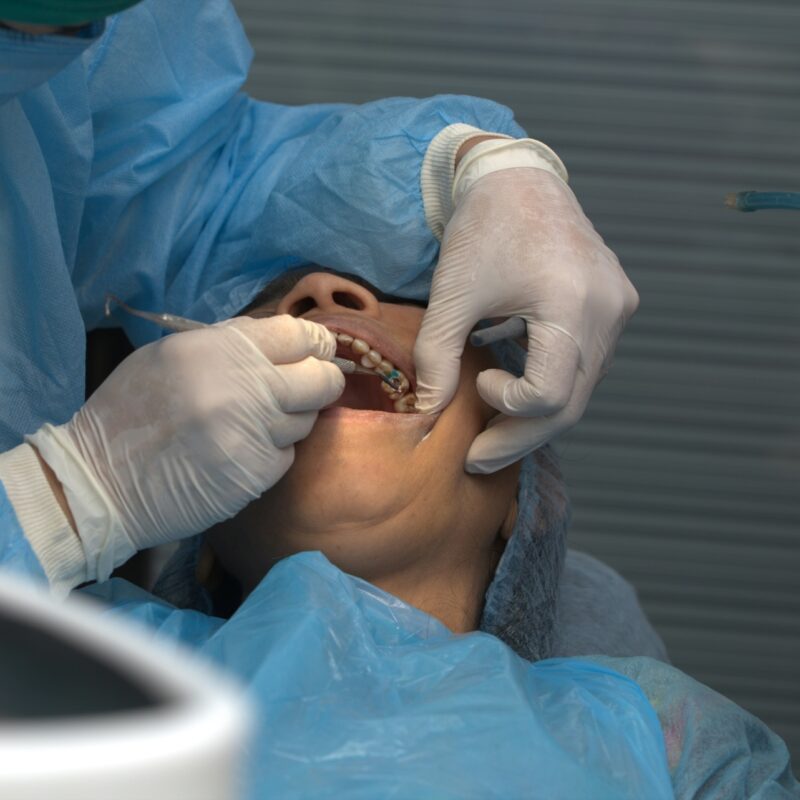 Dentist putting filling on a tooth.