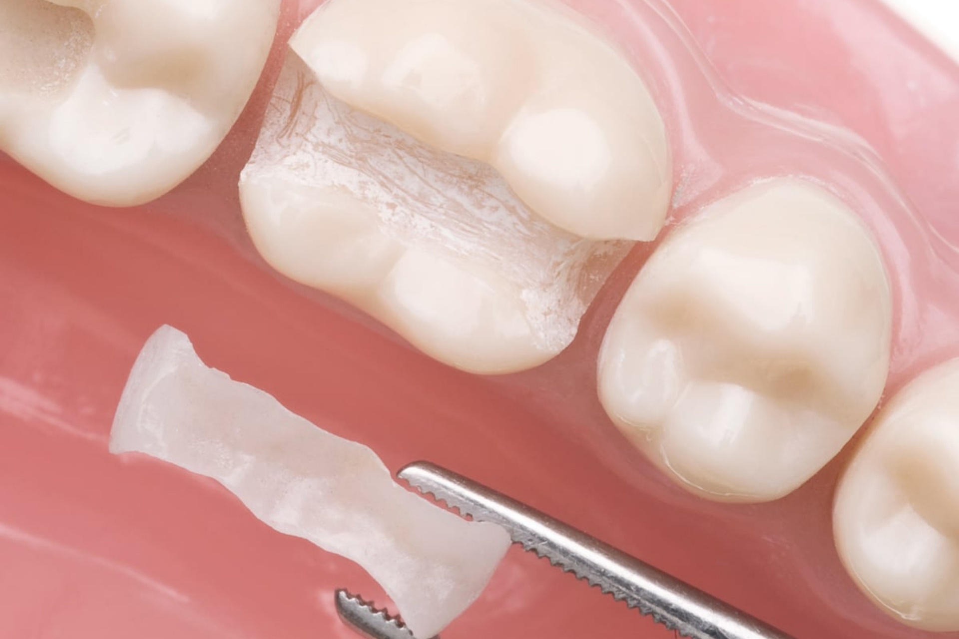 Ceramic fillings
