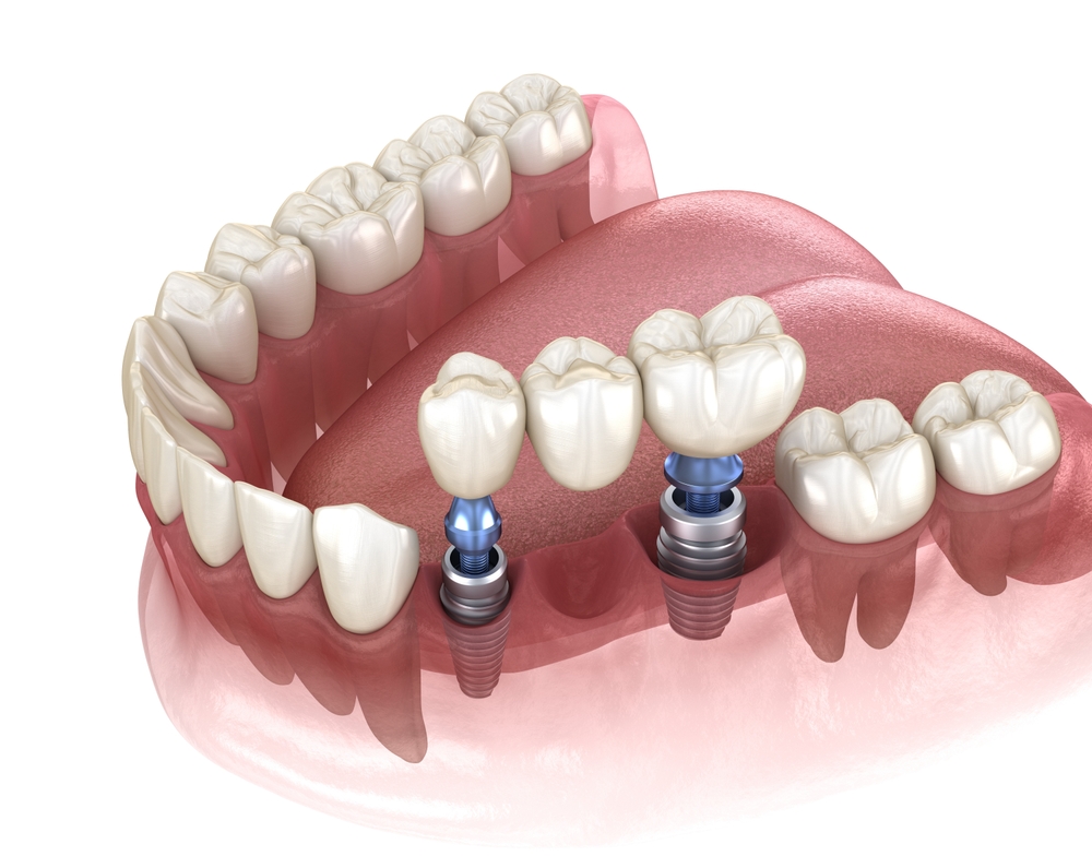 Dental bridge supported by dental implants. 3D illustration of human teeth and dentures concept