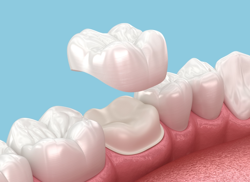 Dental crowns placement over molar tooth 3D illustration Dental crowns placement over molar tooth 3D illustration
