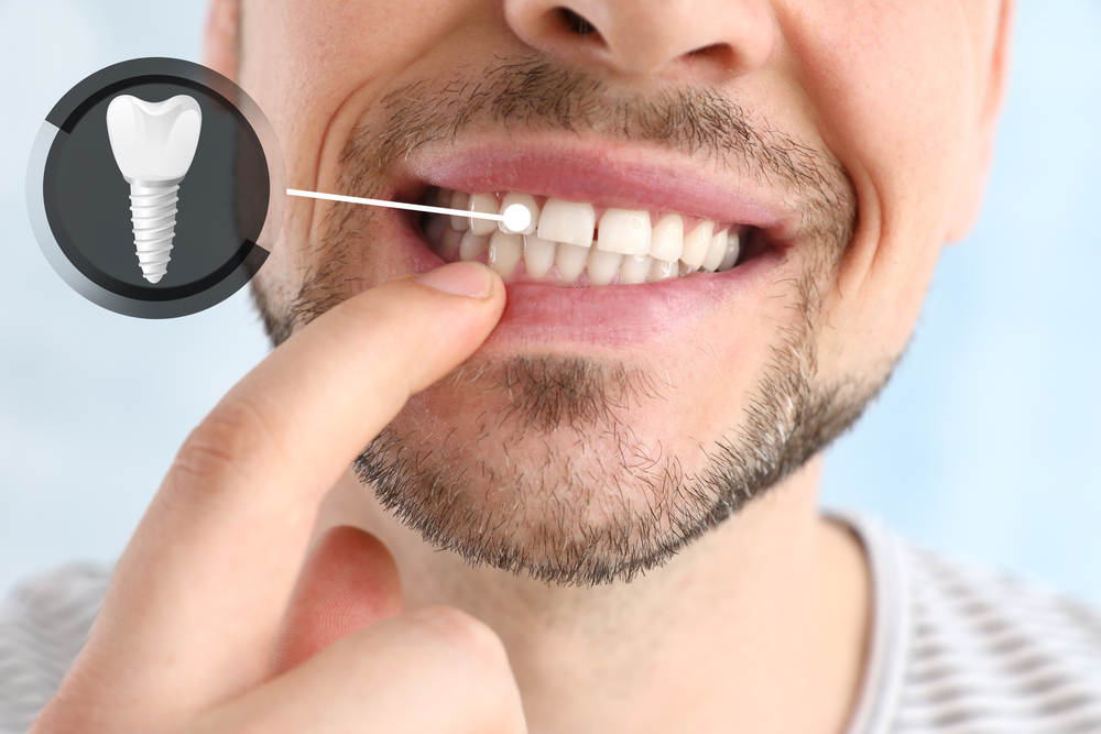 Man showing dental implants Man showing dental implants