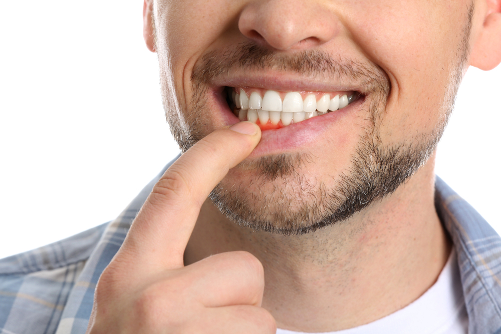 Man showing healthy gums and white teeth - Dentist in Bonney Lake WA Close-up of a man pointing to his gumline and bright smile, emphasizing gum health and dental hygiene - Dentist in Bonney Lake WA