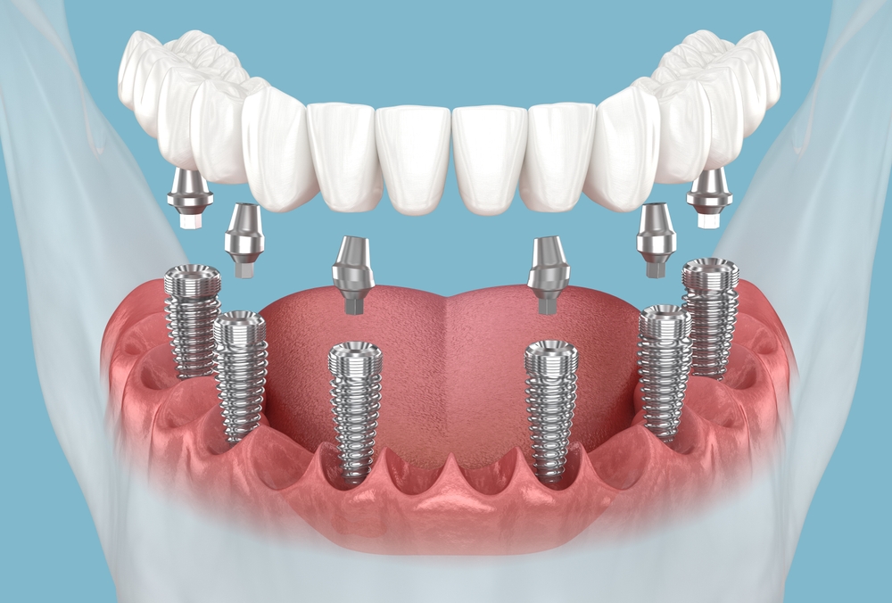 Mandibular prosthesis with gum All on 6 system supported by dental implants. 3D illustration of human teeth and dentures concept