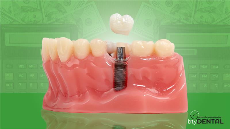 Here is all you need to know about the average cost of molar implants in Washington