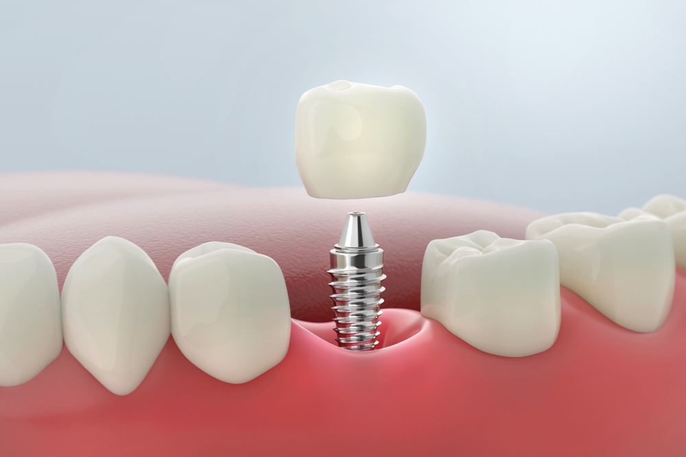 Dental implant with crown restoration - Dentist in Lynnwood, WA 3D illustration of a dental implant showing the titanium post and crown placement to restore missing teeth - Dentist in Lynnwood, WA