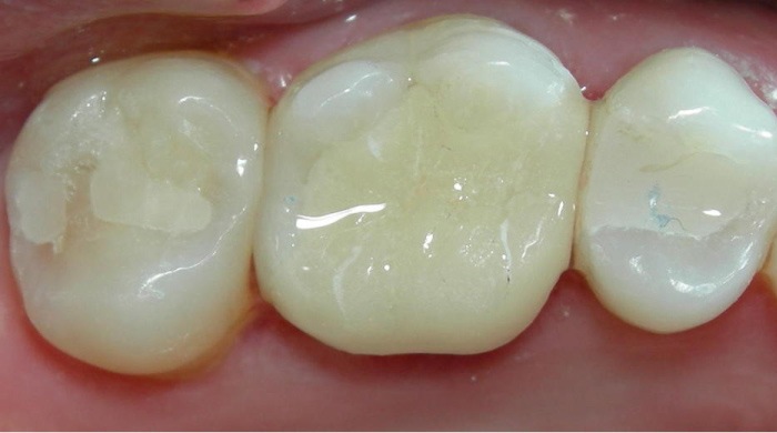 Composite fillings are the same color as teeth making it seamless and natural