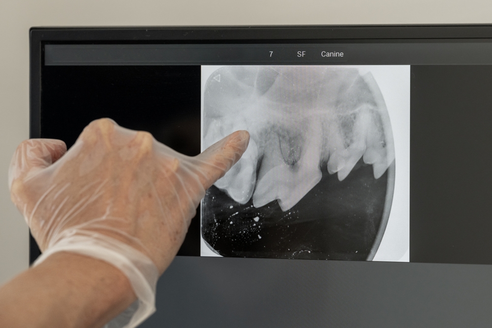Dentist explaining dental x-ray - Dentist in Lynnwood WA Dentist explaining dental x-ray - Dentist in Lynnwood WA