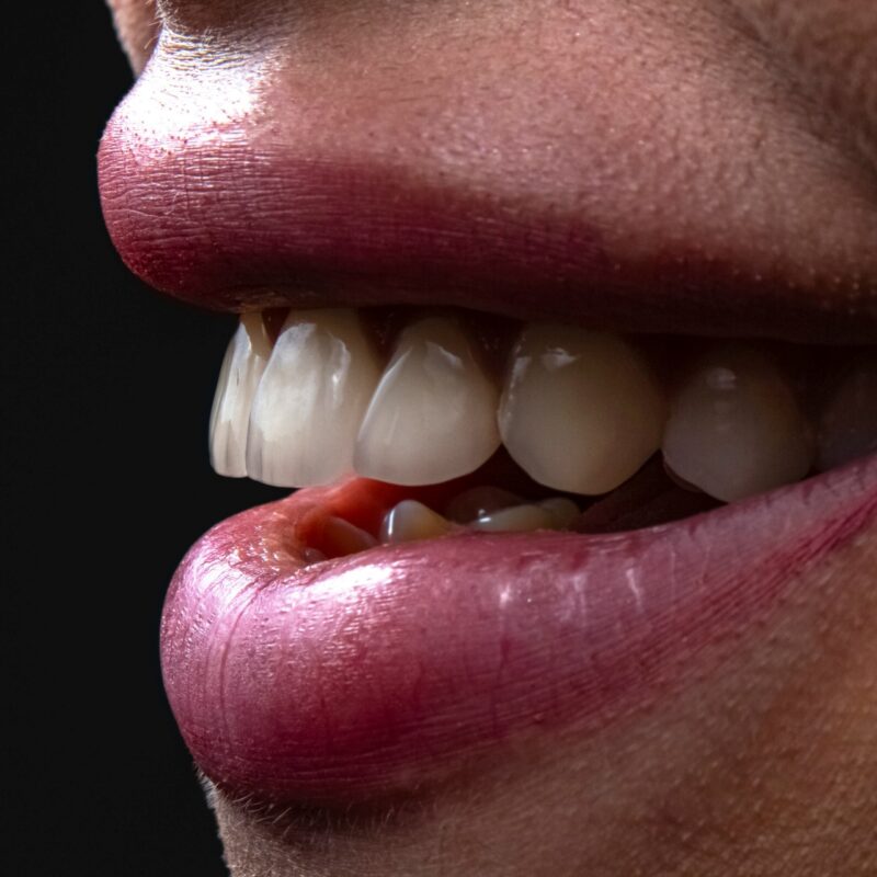 porcelain implants in washington