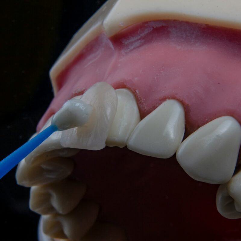 Here's a breakdown of how much veneers cost in Washington
