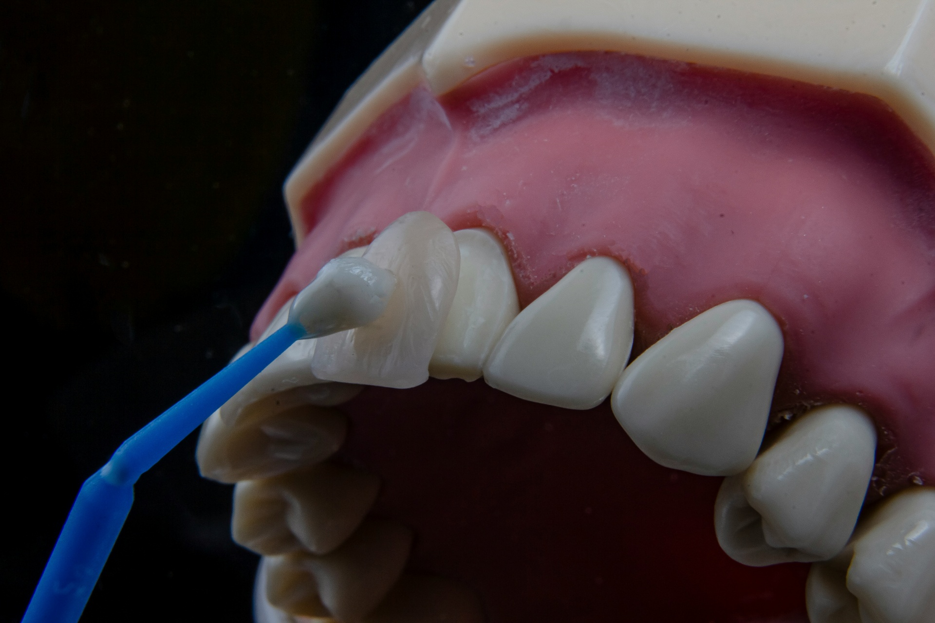 Here's a breakdown of how much veneers cost in Washington